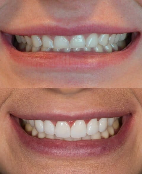 Cosmetic Dentistry treatment before and after
