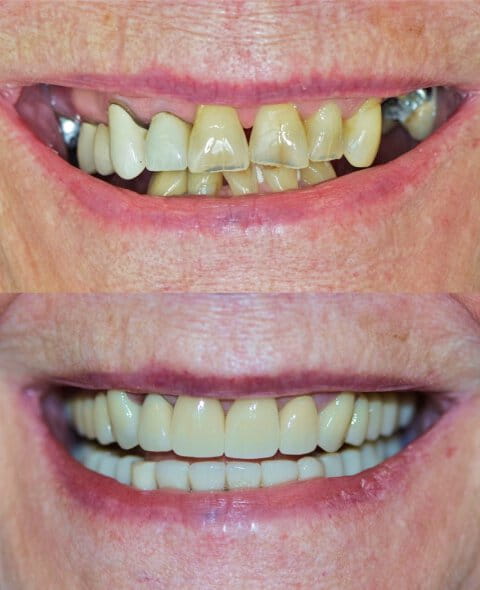 Restorative Dentistry before and after
