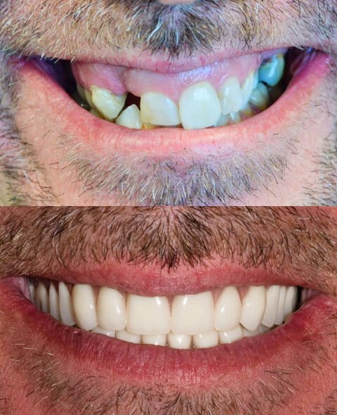 Dentures before and after
