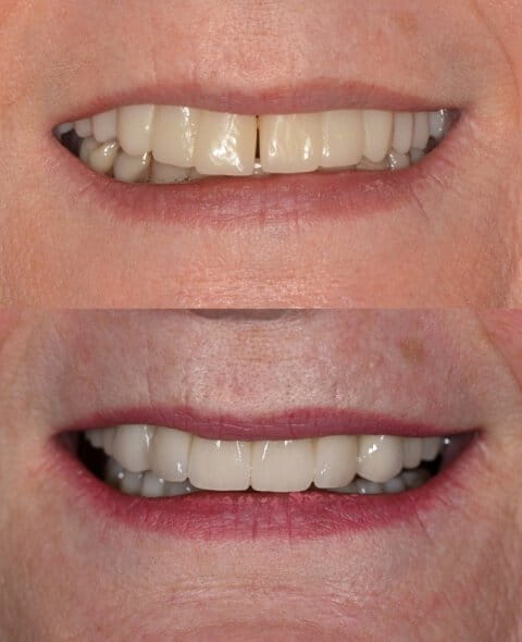 Cosmetic Dentistry before and after