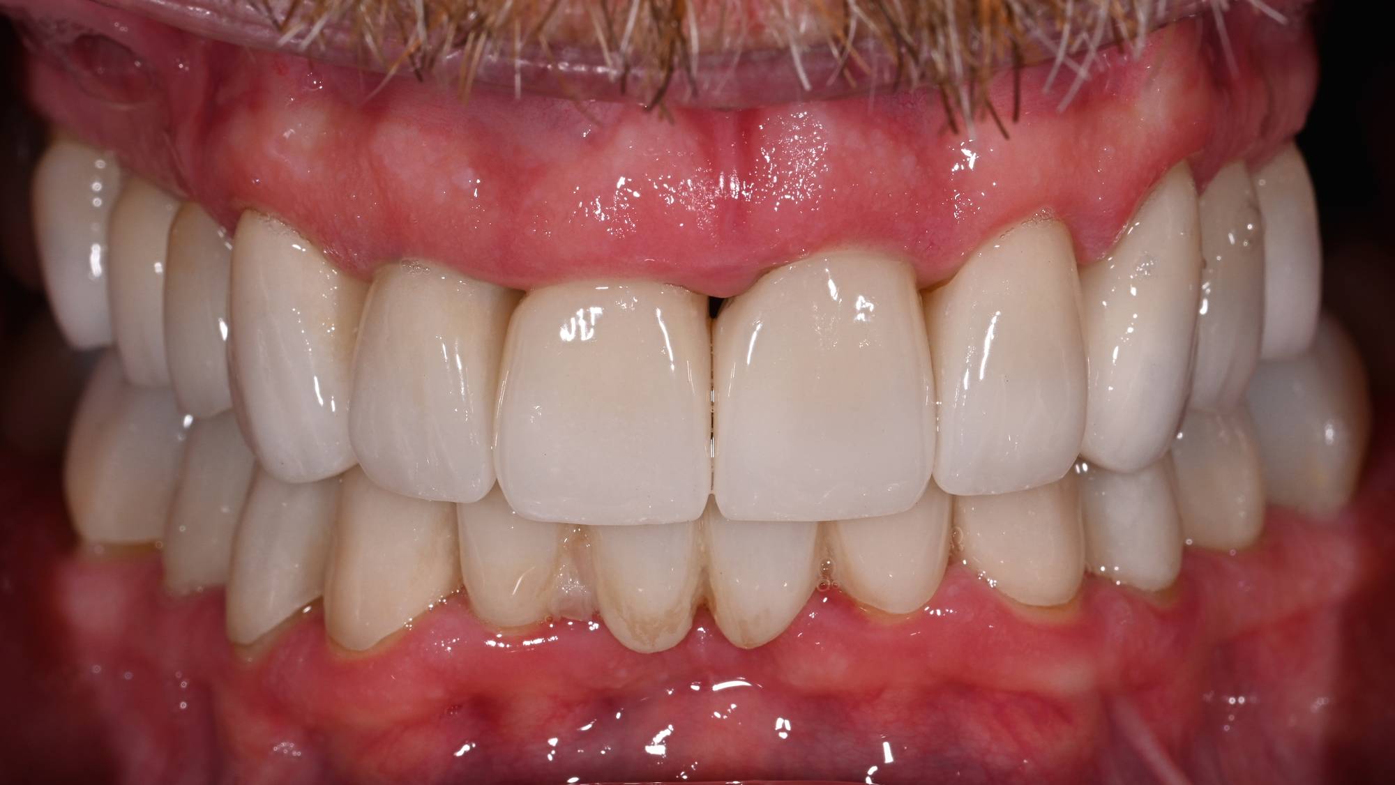 Crowns Before & After Image