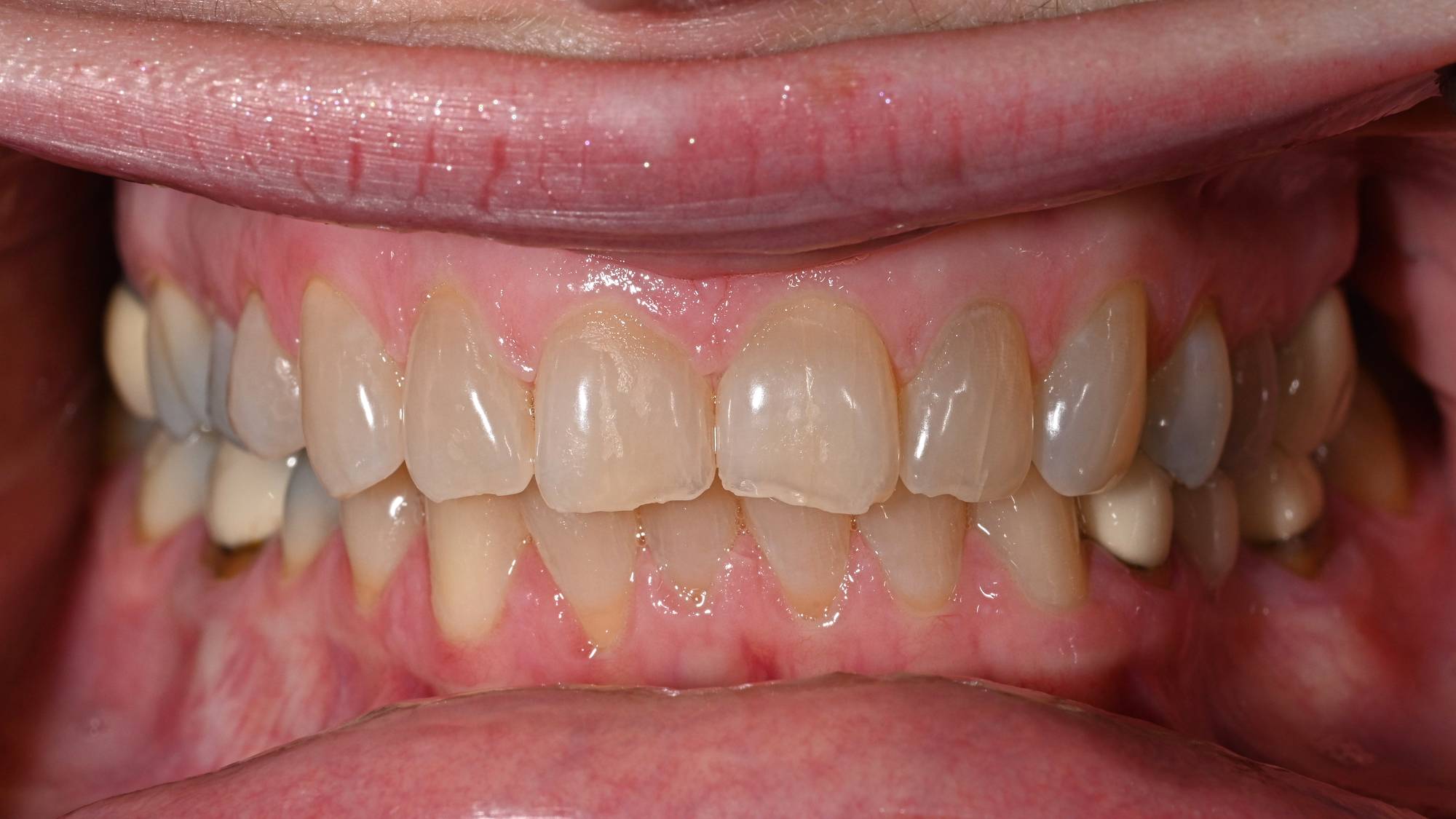 Crowns Before & After Image