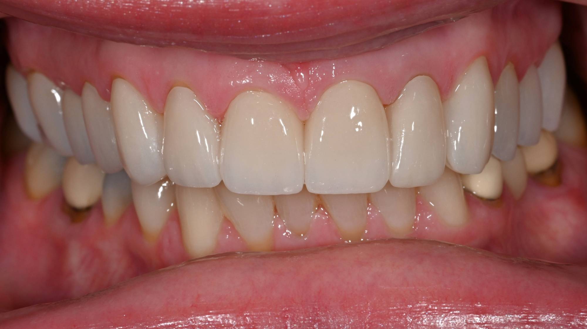 Crowns Before & After Image