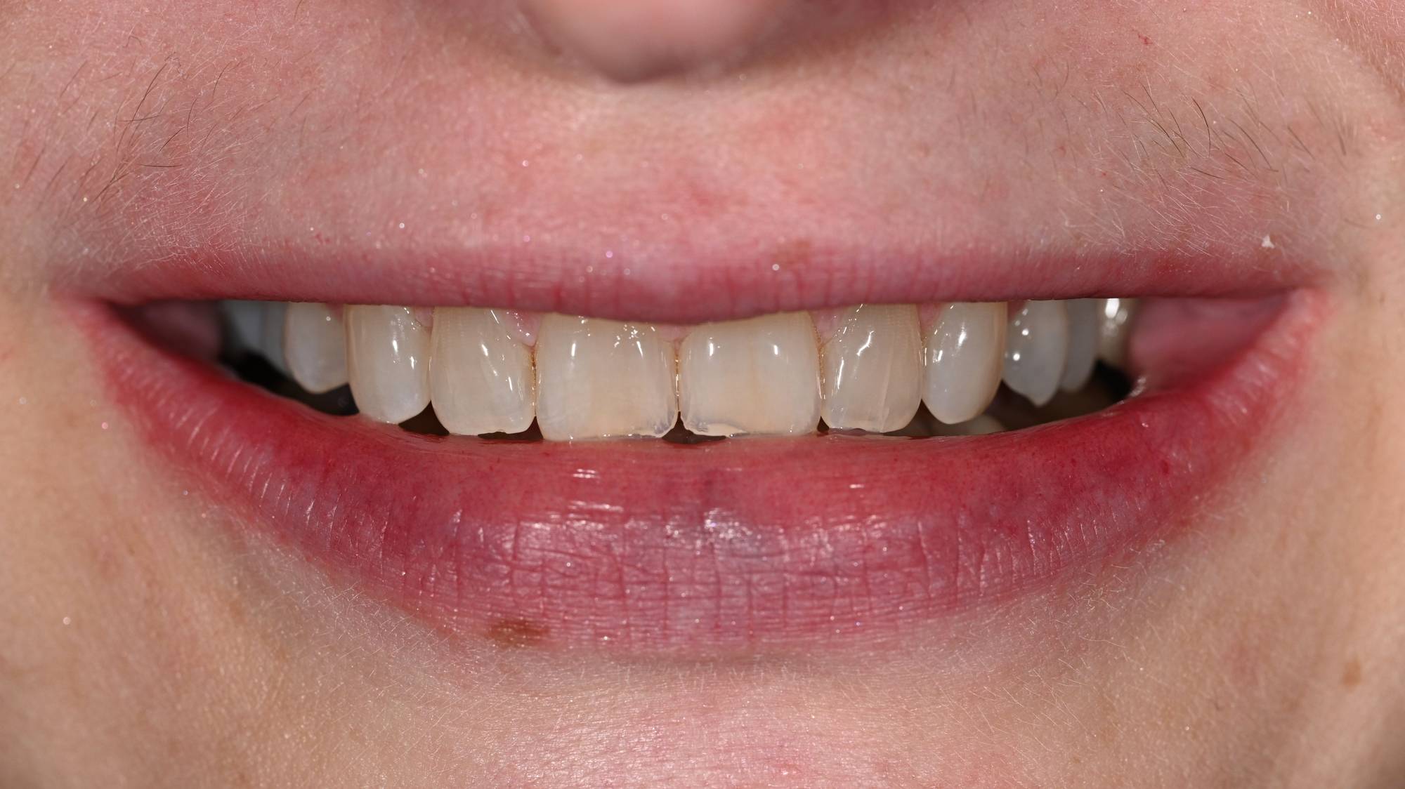 Crowns Before & After Image