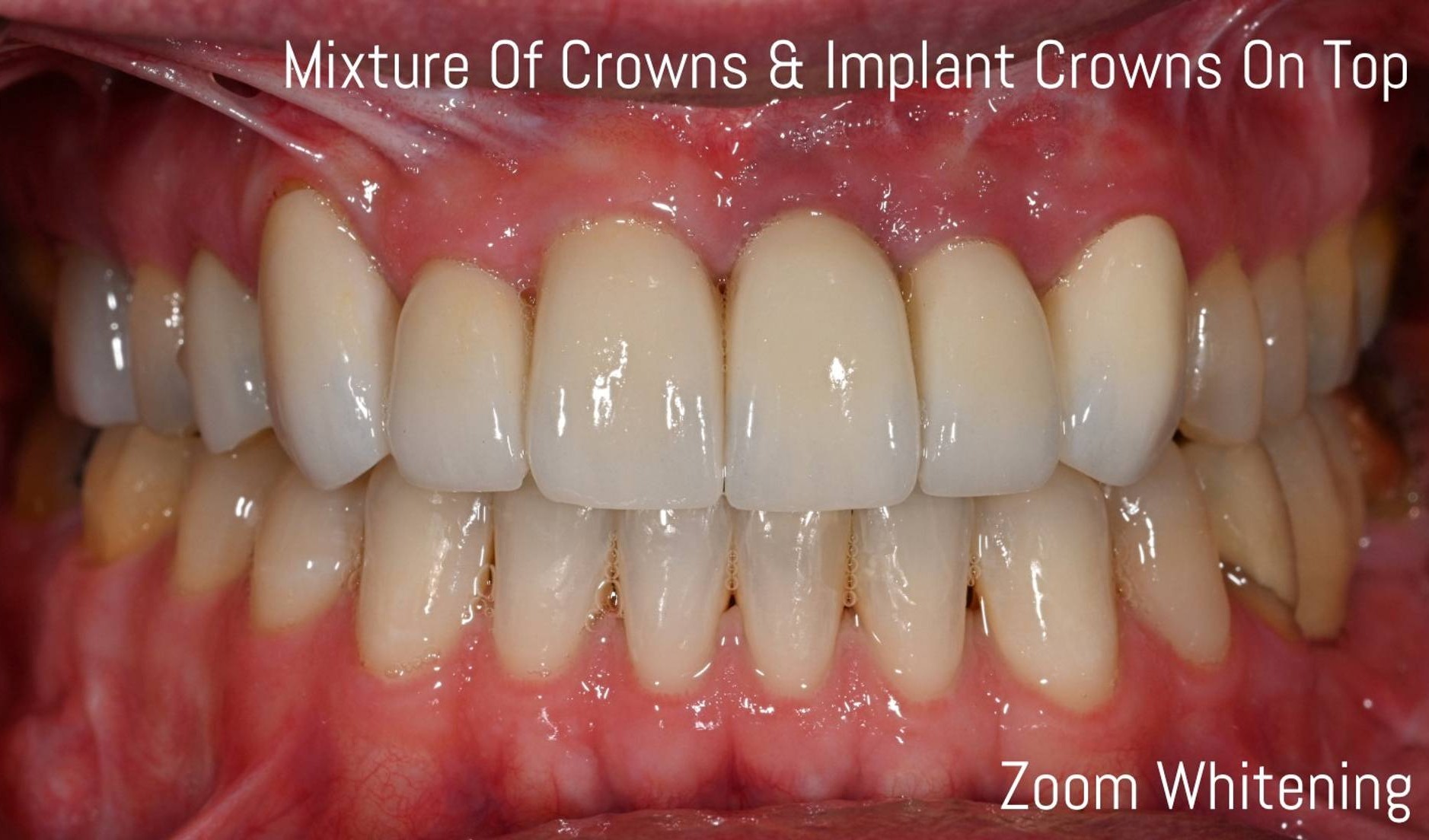 Crowns Before & After Image