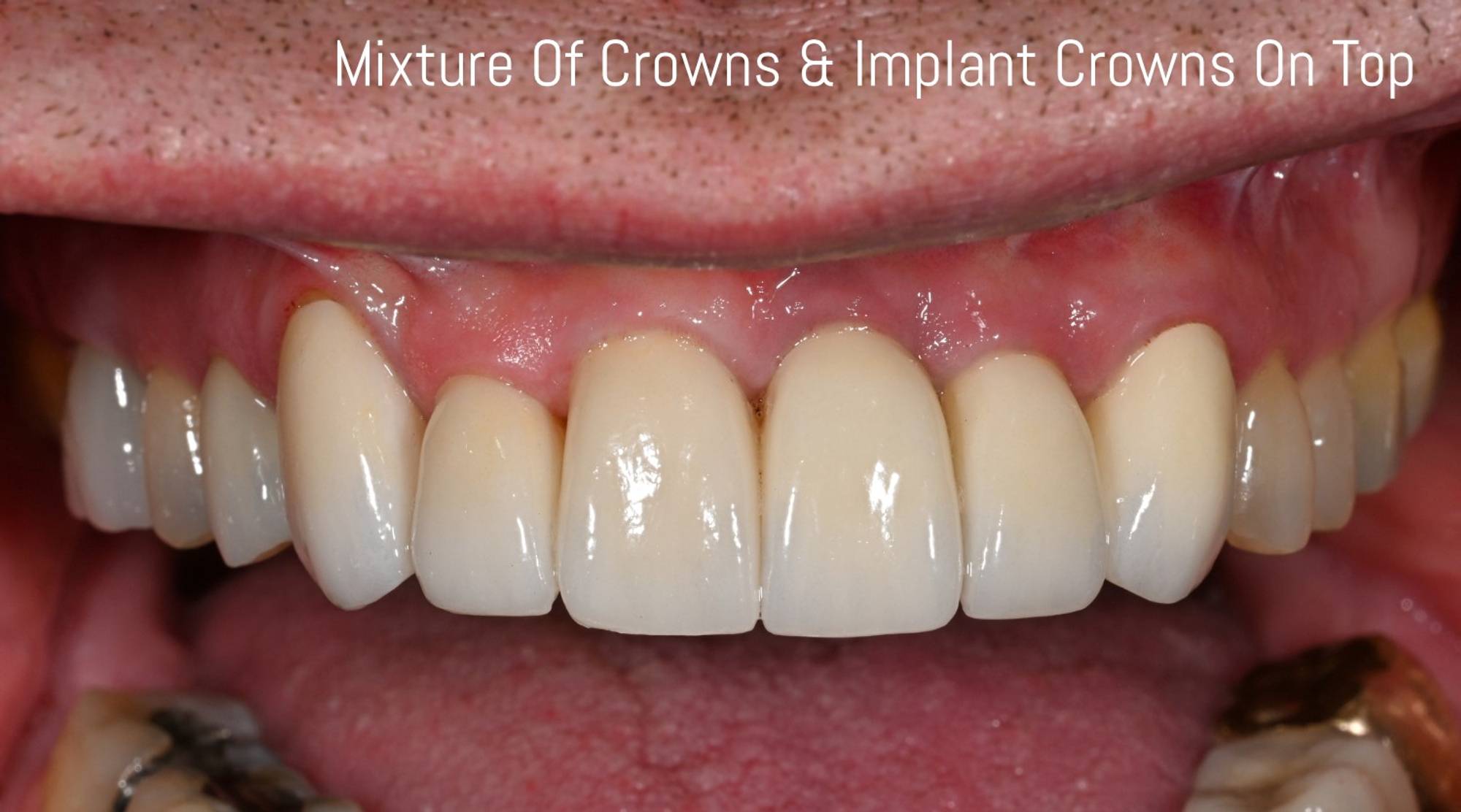 Crowns Before & After Image