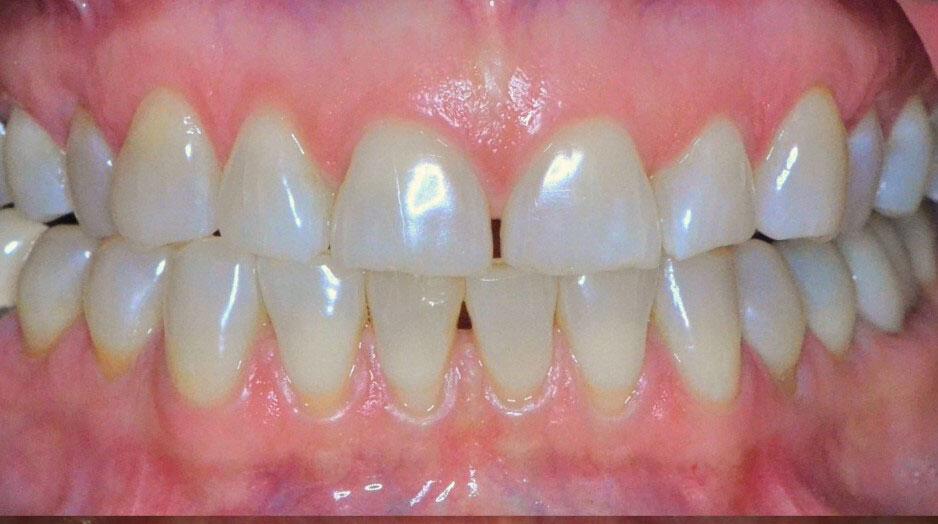 Crowns Before & After Image