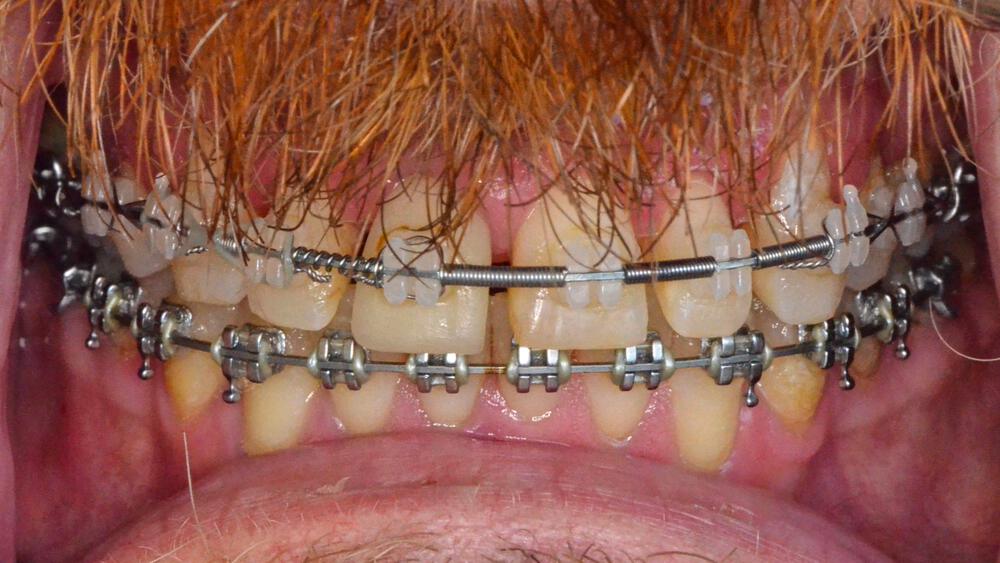 Crowns Before & After Image