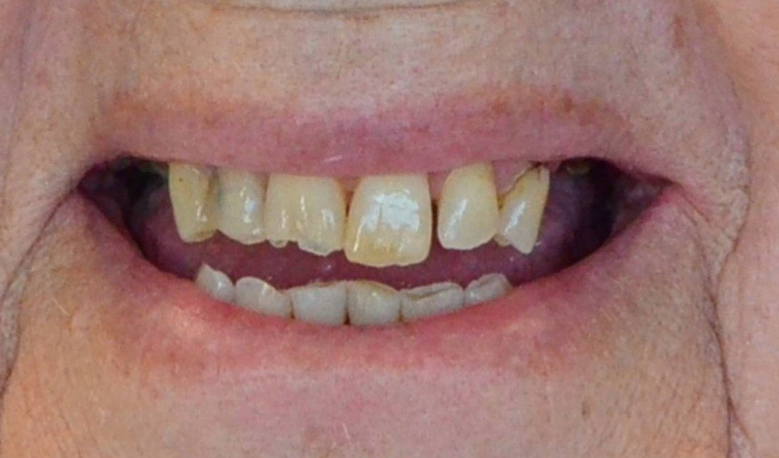 Dental Implants Before & After Image