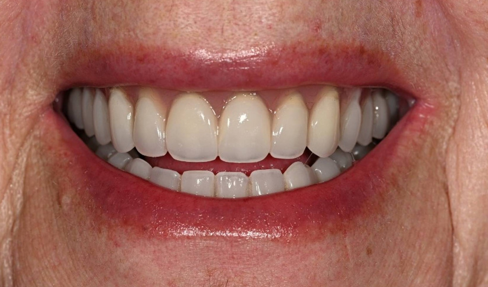 Dental Implants Before & After Image