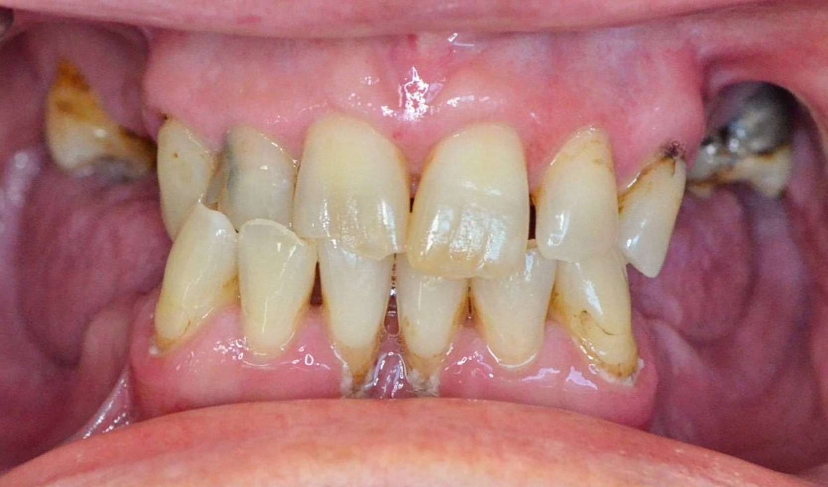 Dental Implants Before & After Image