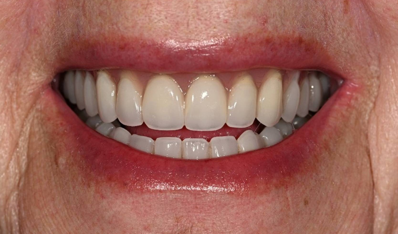 Dental Implants Before & After Image