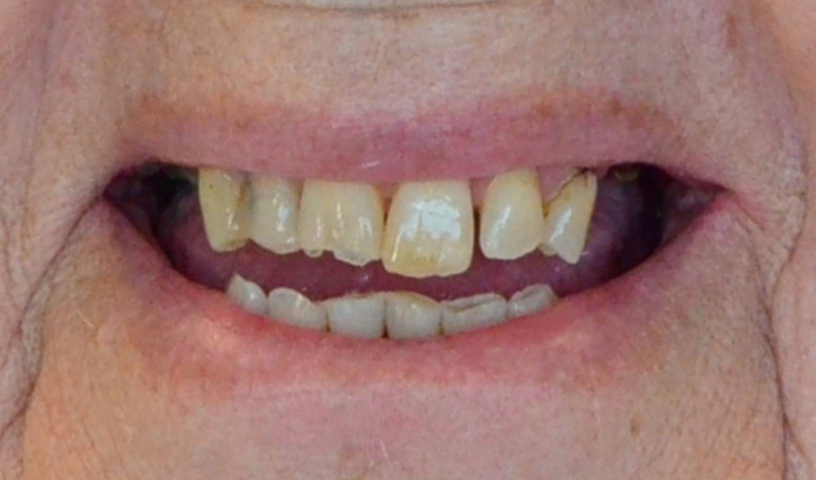 Dental Implants Before & After Image