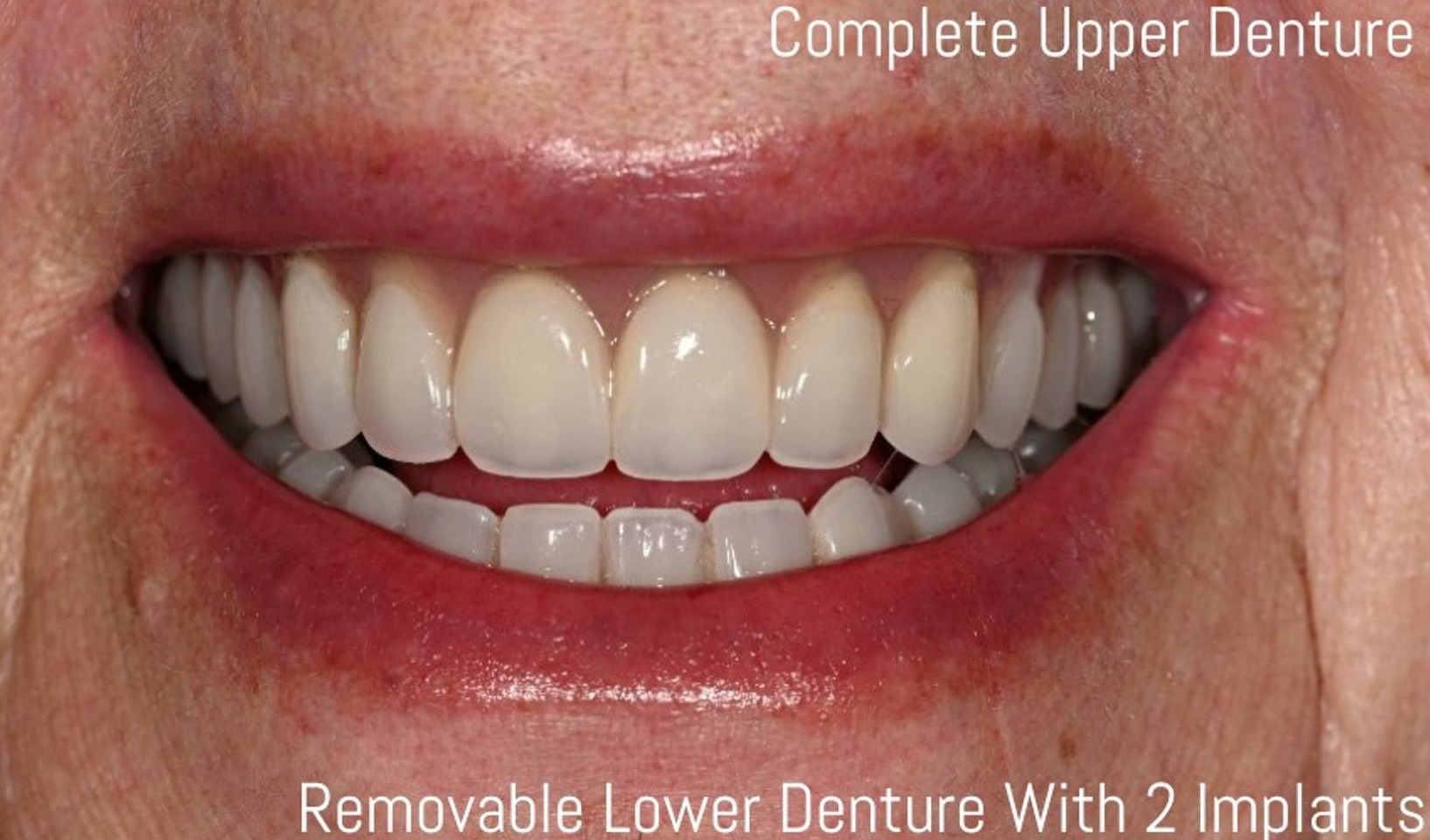 Dental Implants Before & After Image