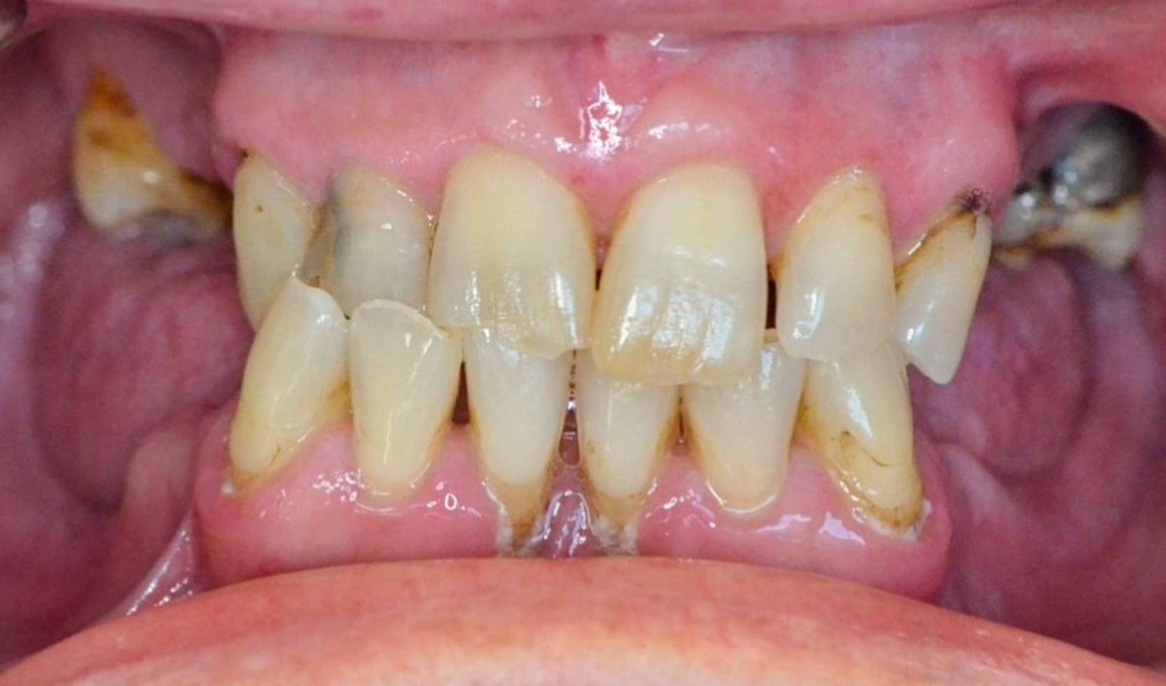 Dental Implants Before & After Image