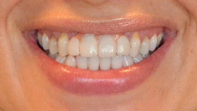 Dental Implants Before & After Image