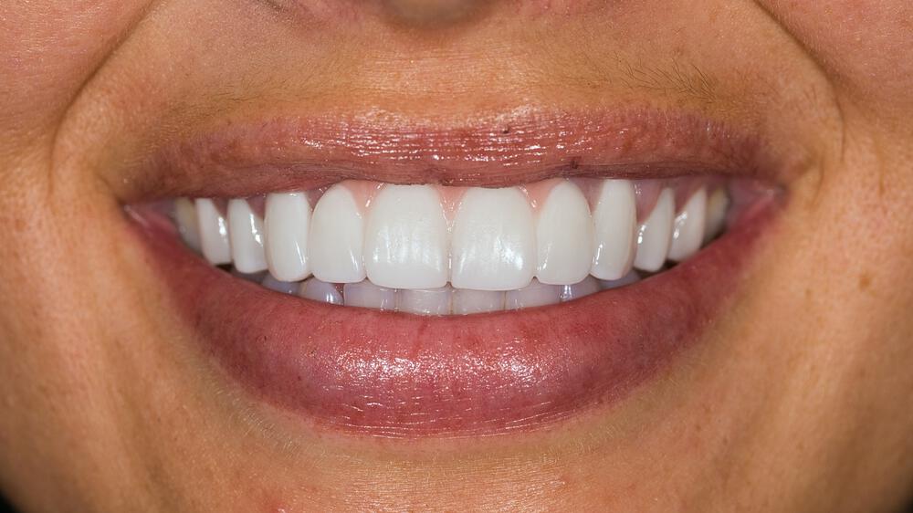 Dental Implants Before & After Image