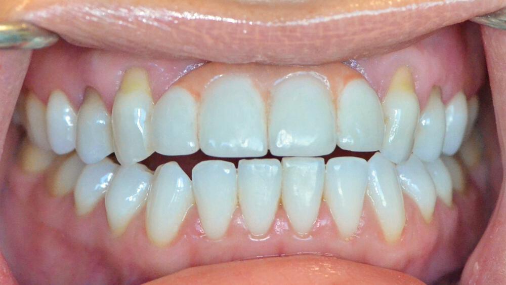 Dental Implants Before & After Image