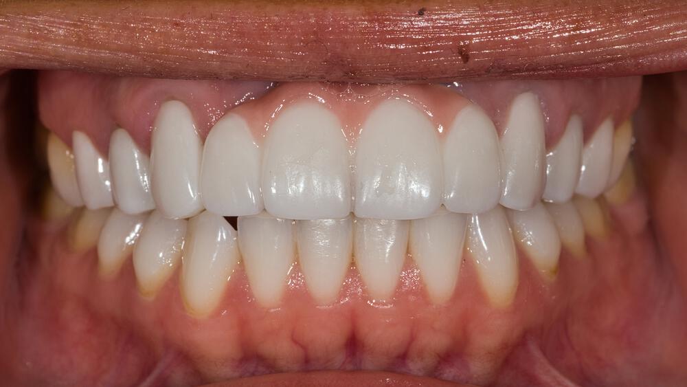 Dental Implants Before & After Image