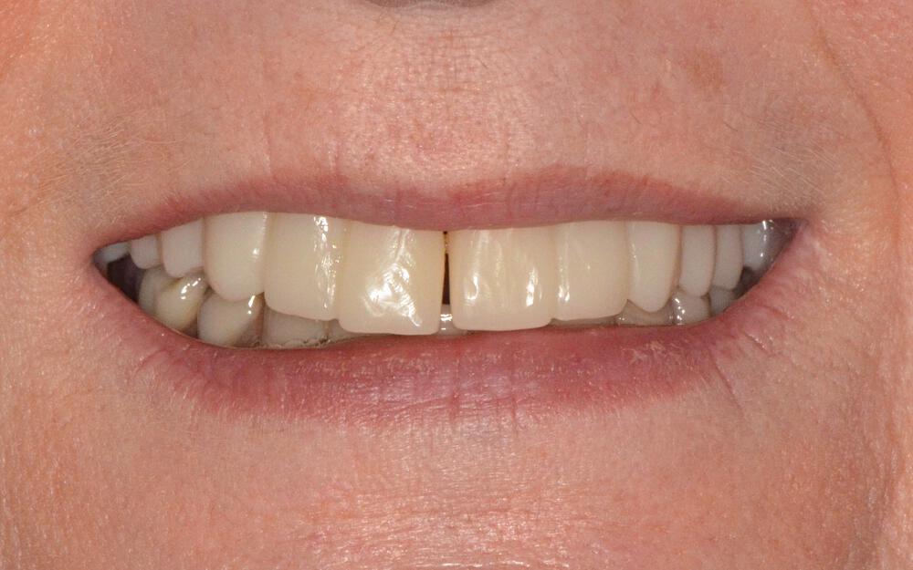 Dental Implants Before & After Image