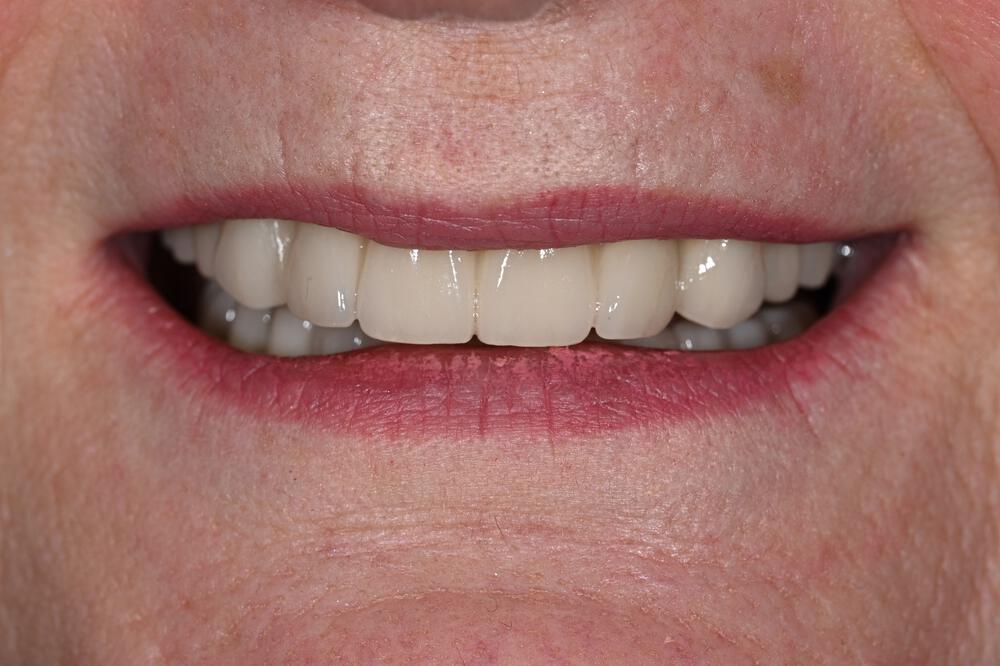 Dental Implants Before & After Image