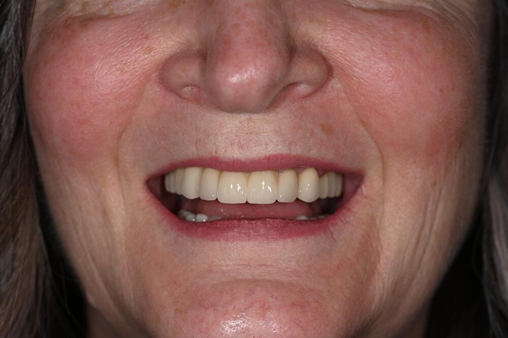 Dental Implants Before & After Image