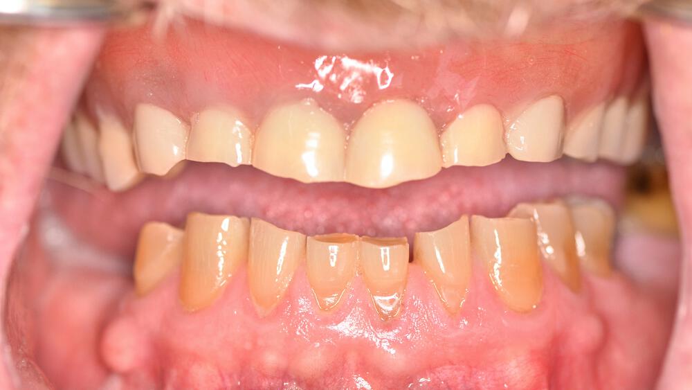 Dental Implants Before & After Image