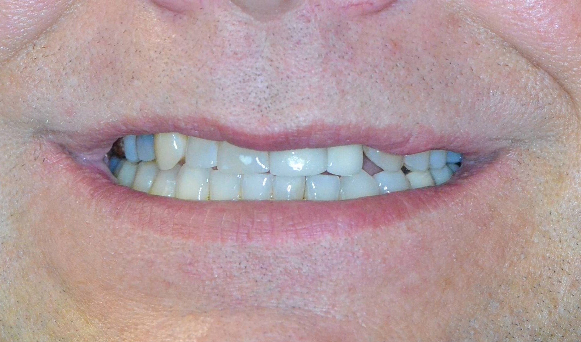 Dental Implants Before & After Image