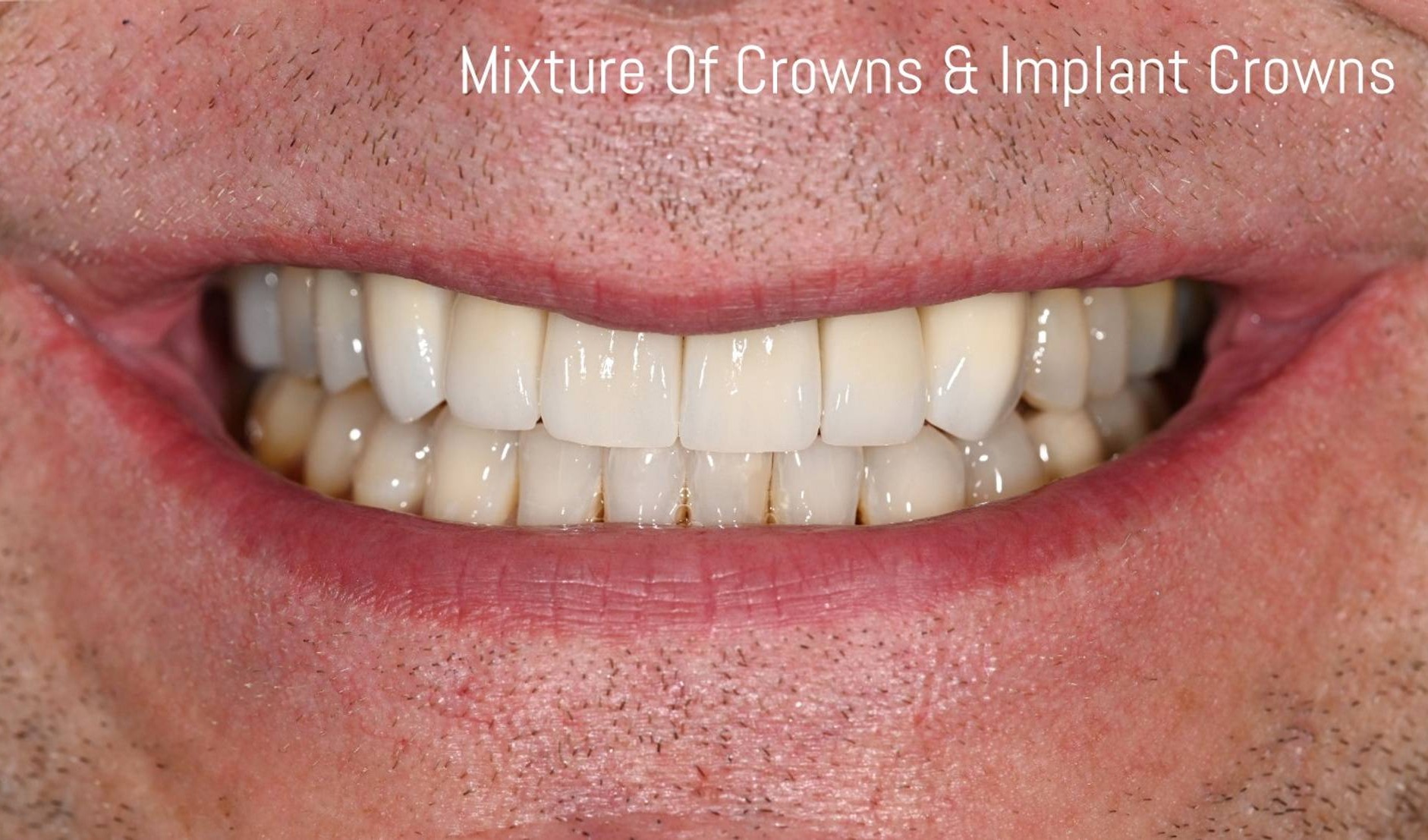 Dental Implants Before & After Image