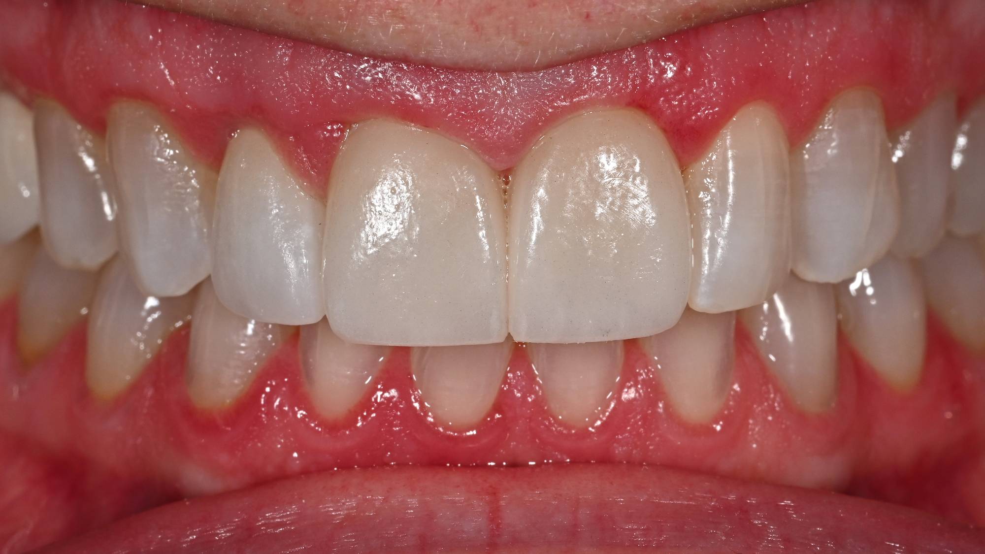 Dental Implants Before & After Image