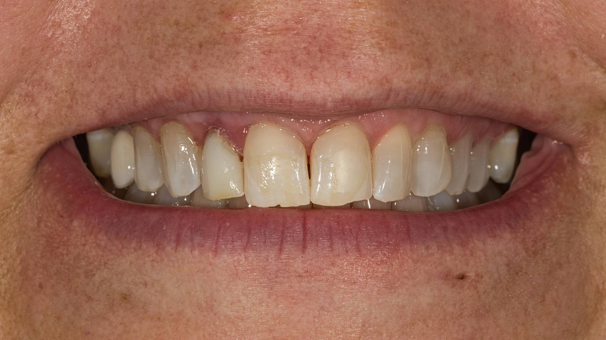 Dental Implants Before & After Image