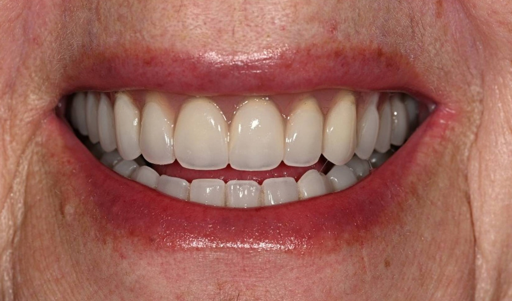 Dentures Before & After Image