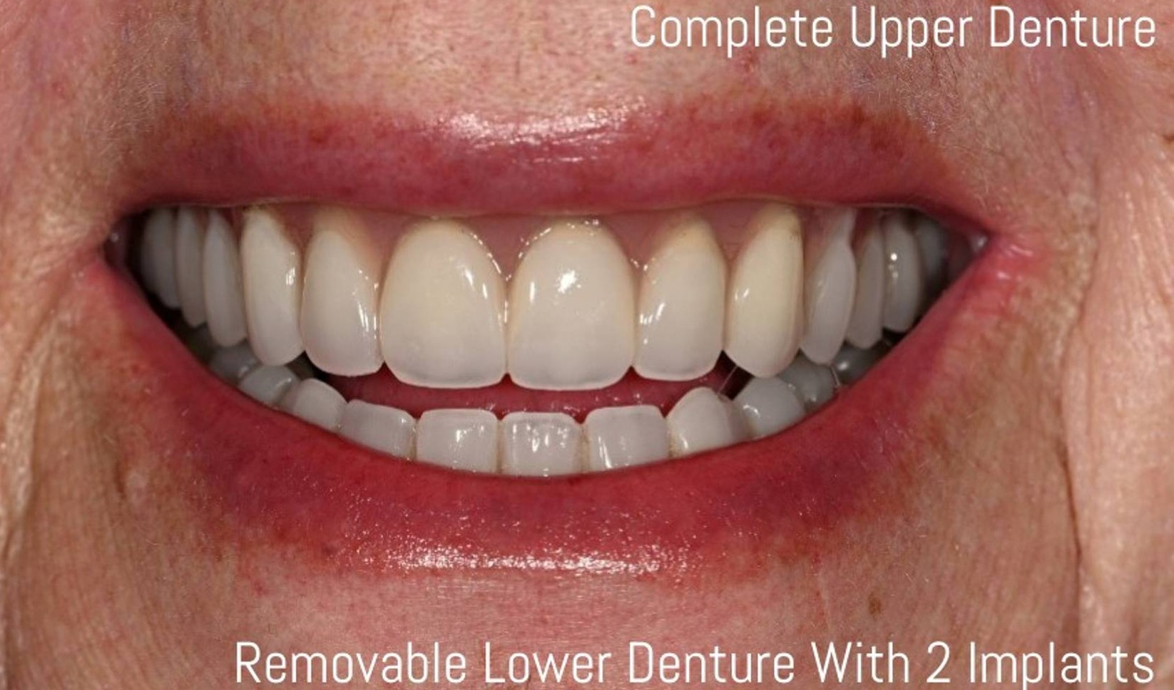 Dentures Before & After Image