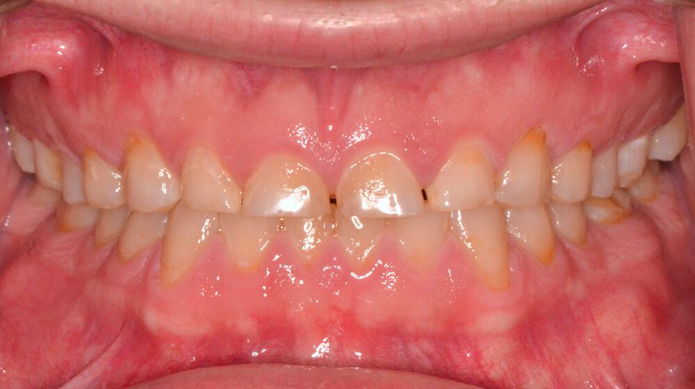 Full Mouth Reconstruction Before & After Image