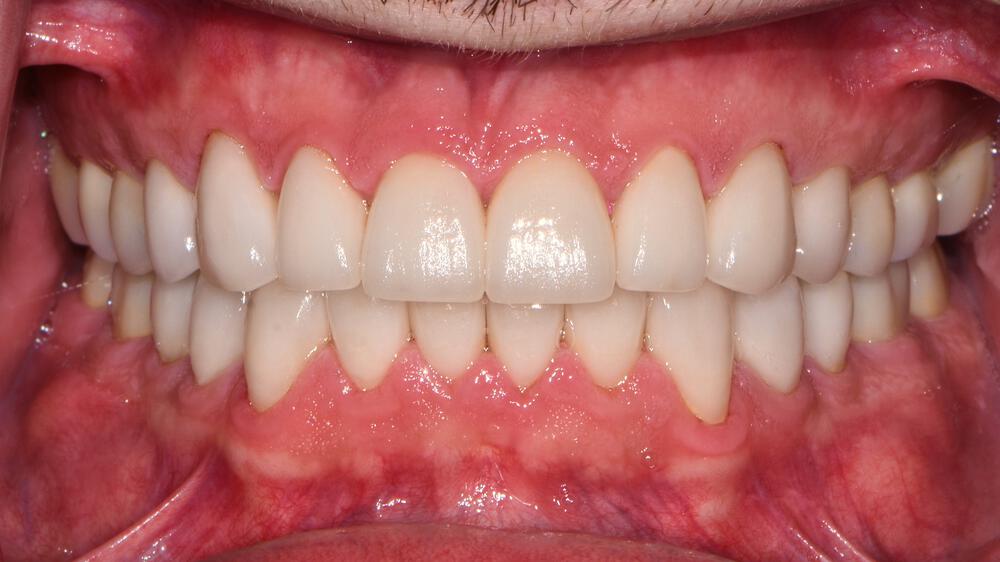 Full Mouth Reconstruction Before & After Image