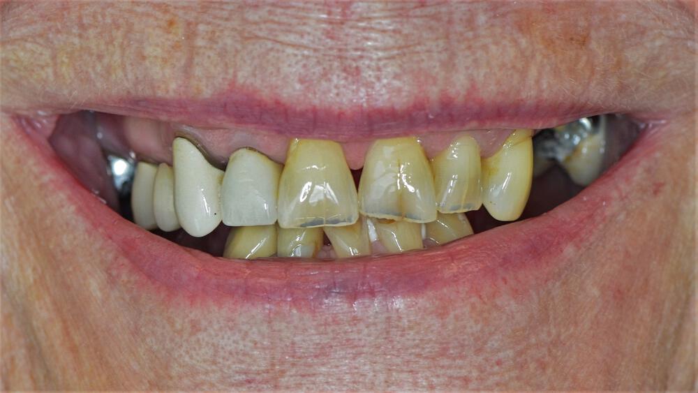 Full Mouth Reconstruction Before & After Image