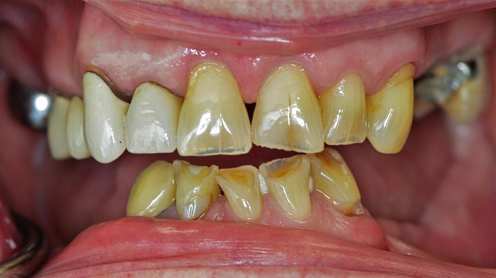 Full Mouth Reconstruction Before & After Image