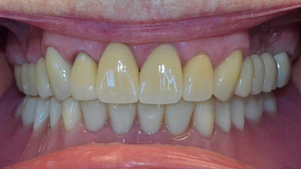 Full Mouth Reconstruction Before & After Image