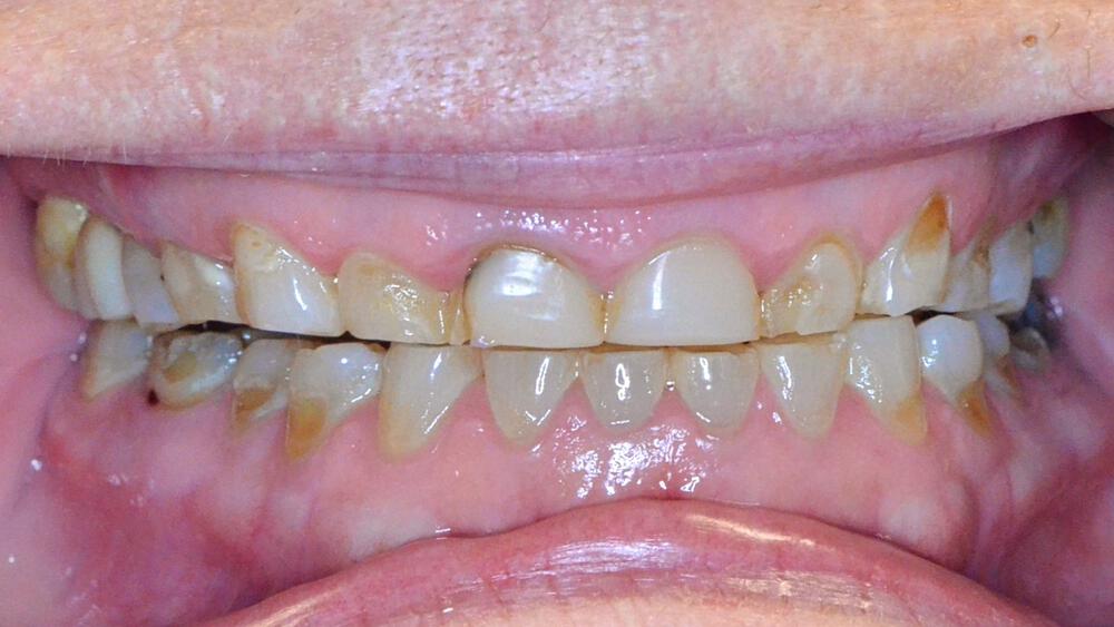 Full Mouth Reconstruction Before & After Image