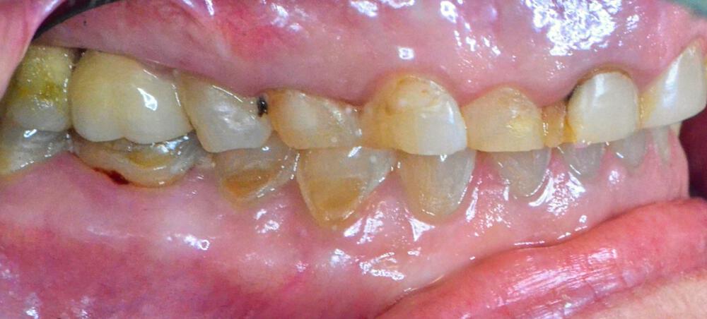 Full Mouth Reconstruction Before & After Image