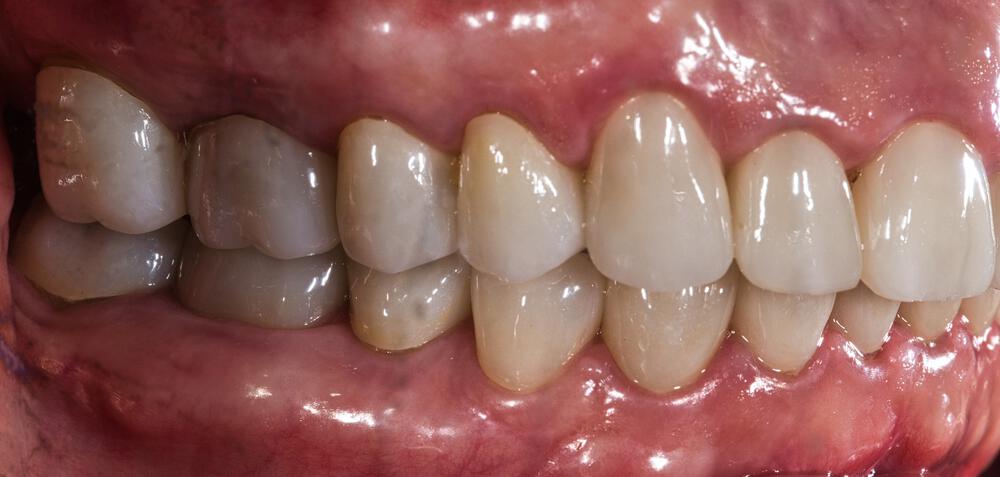 Full Mouth Reconstruction Before & After Image