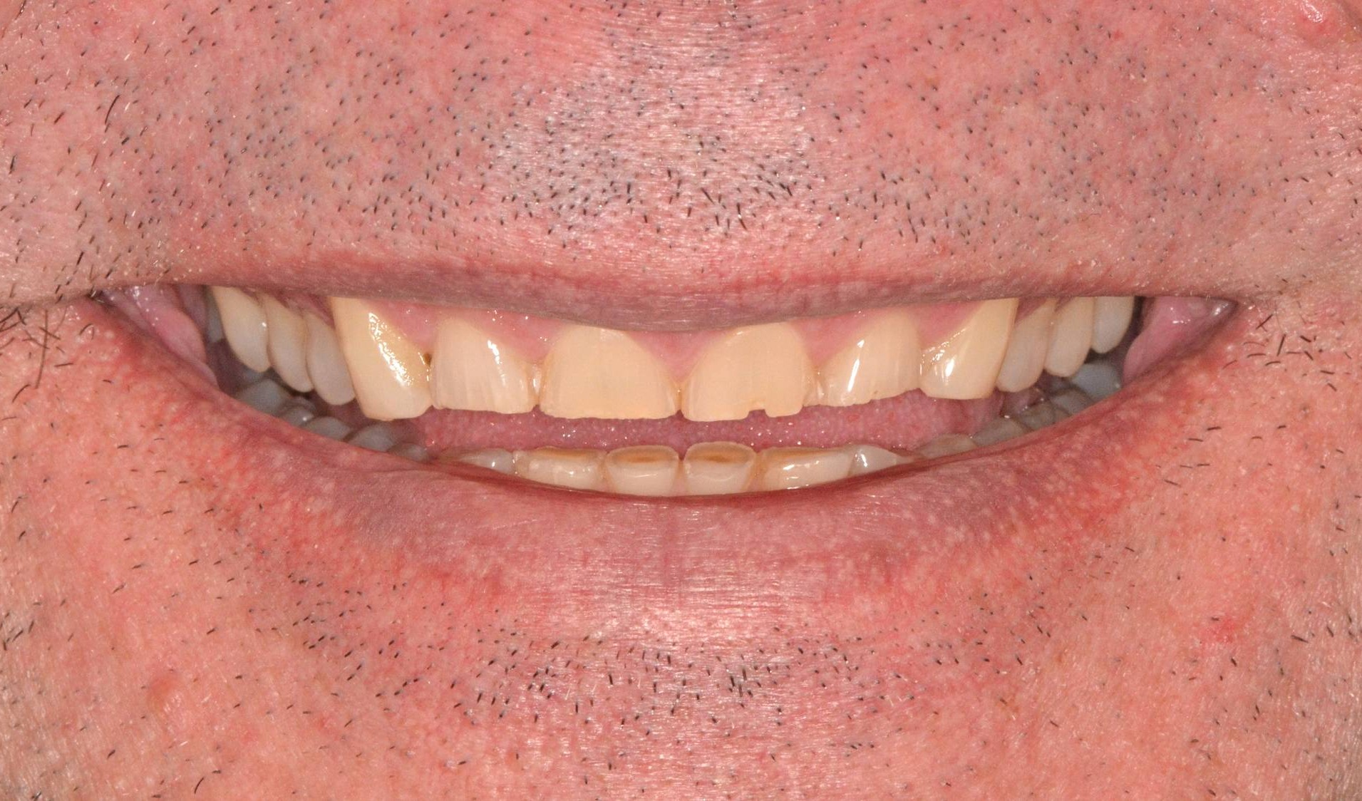 Full Mouth Reconstruction Before & After Image