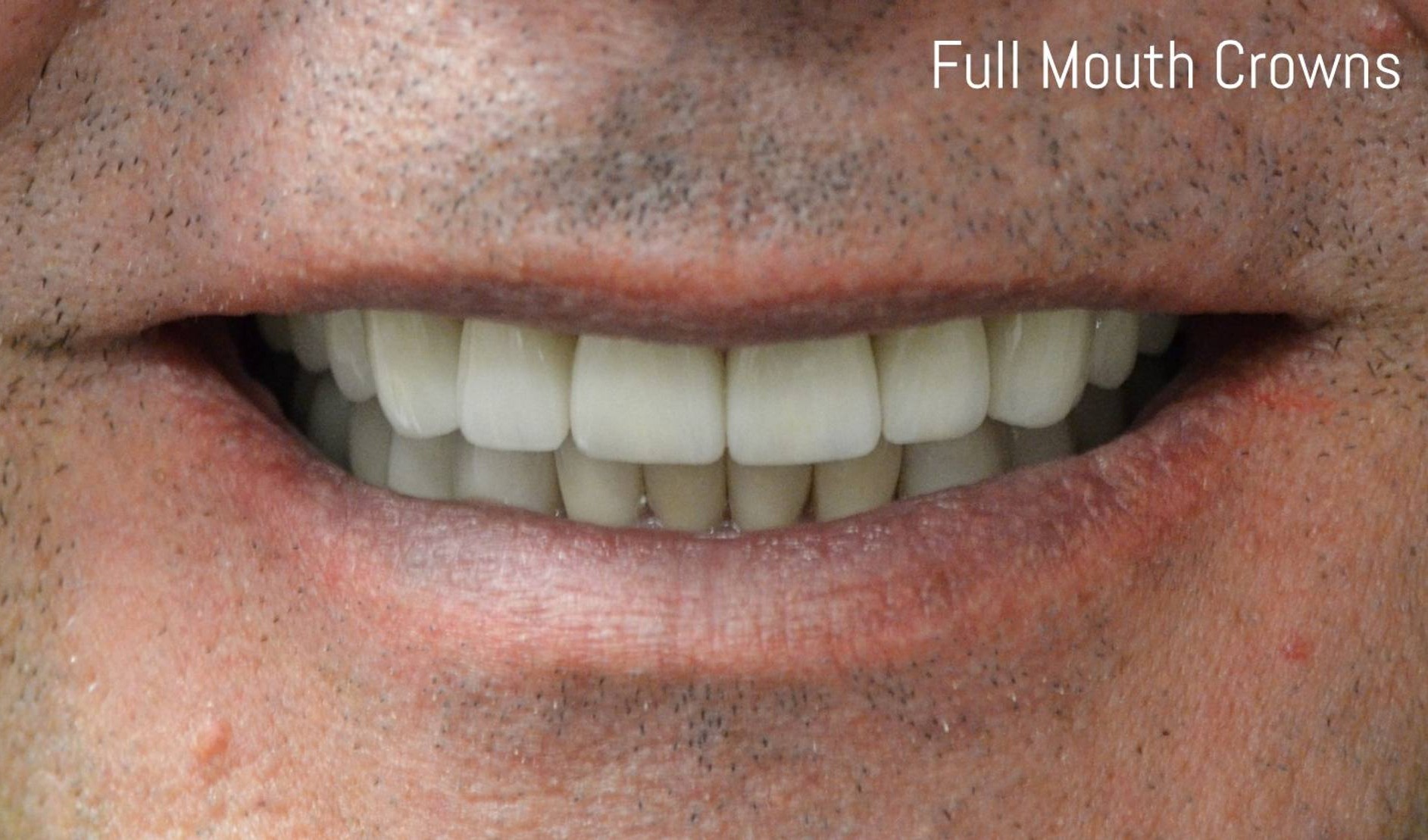 Full Mouth Reconstruction Before & After Image