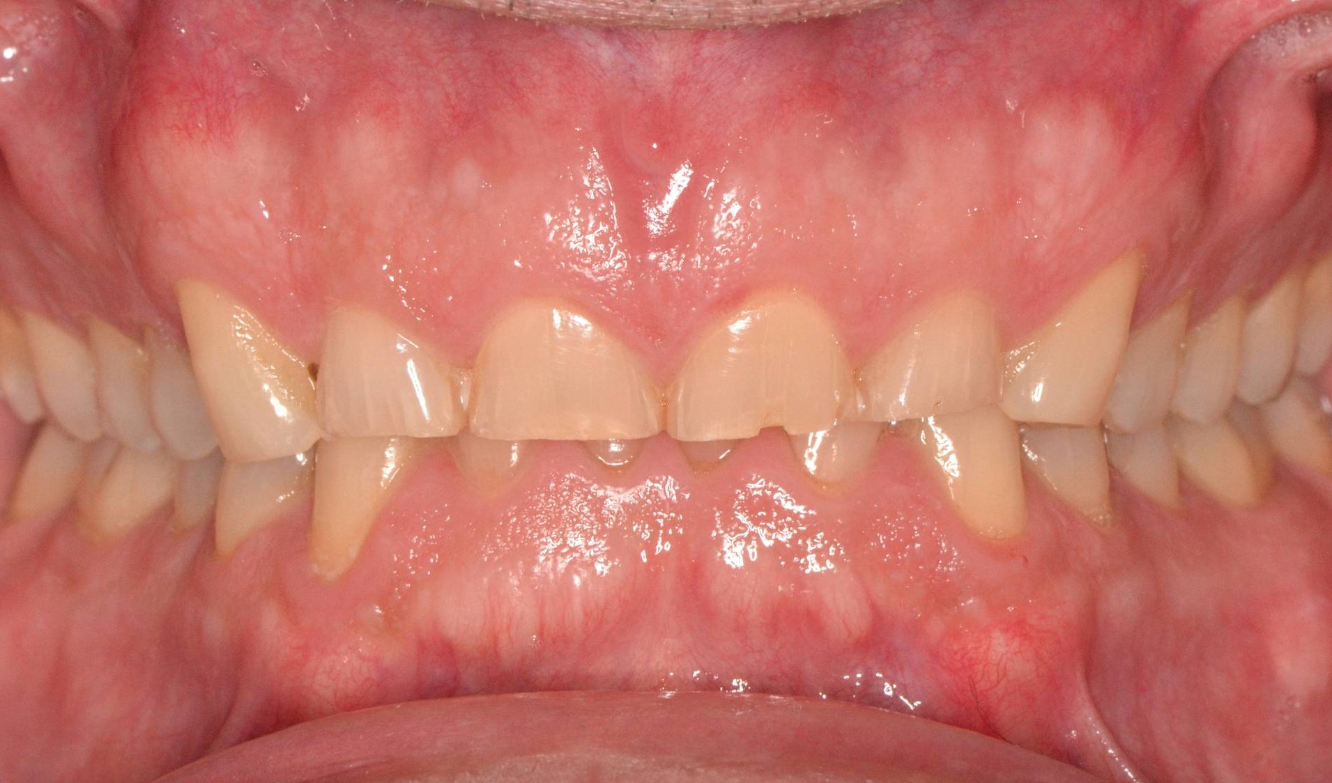 Full Mouth Reconstruction Before & After Image