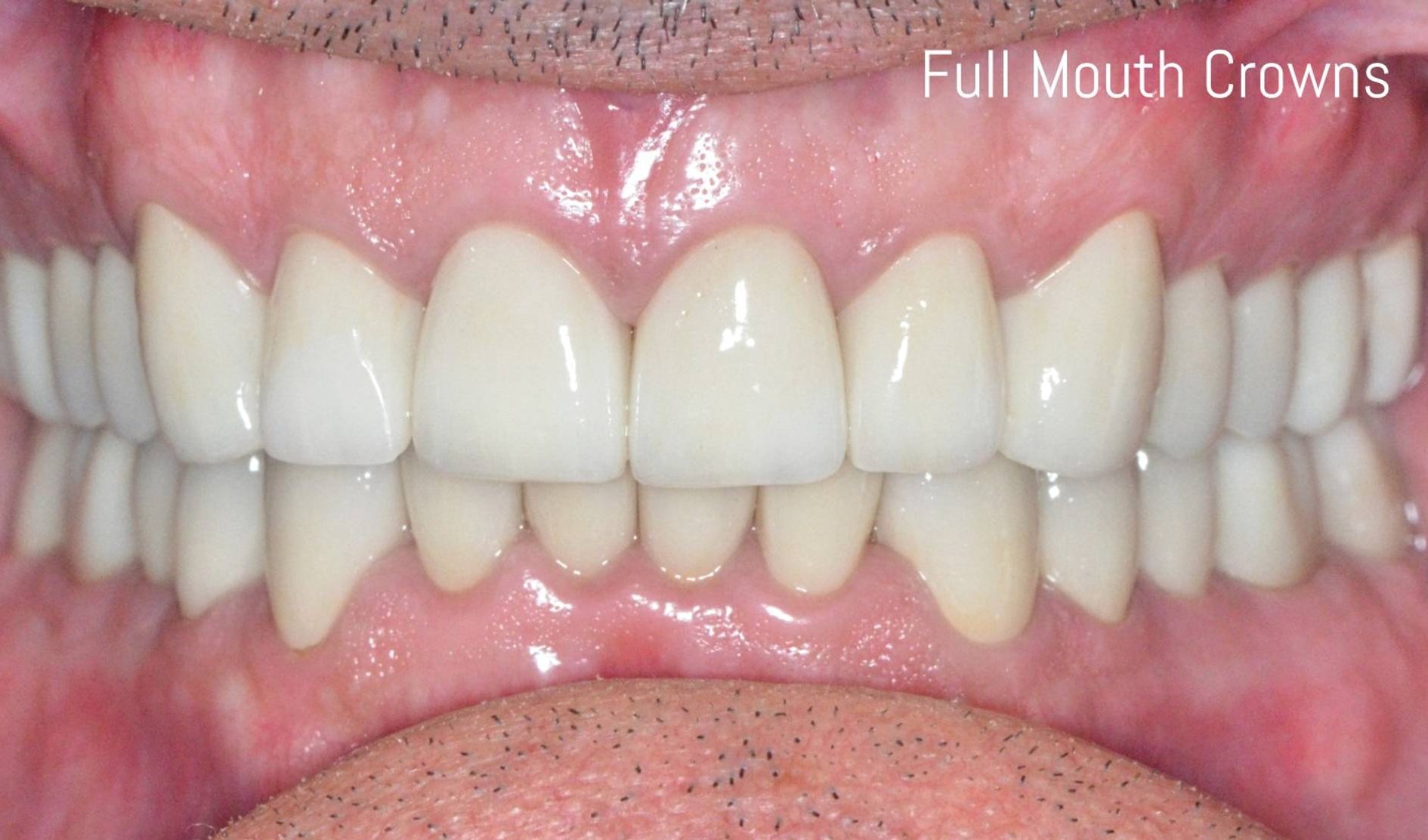 Full Mouth Reconstruction Before & After Image