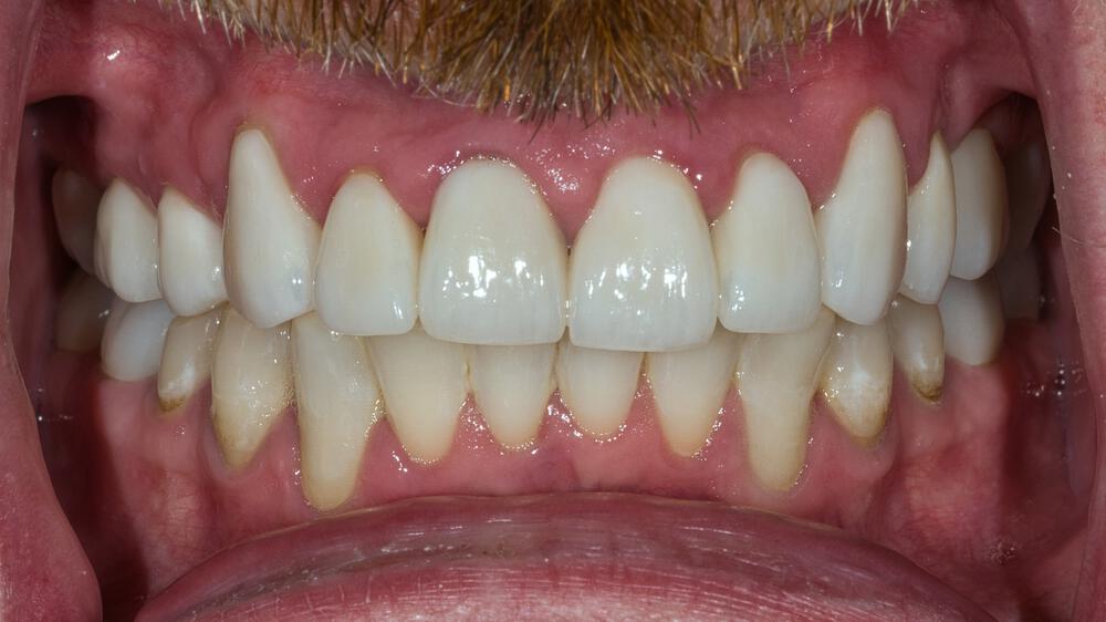 Full Mouth Reconstruction Before & After Image