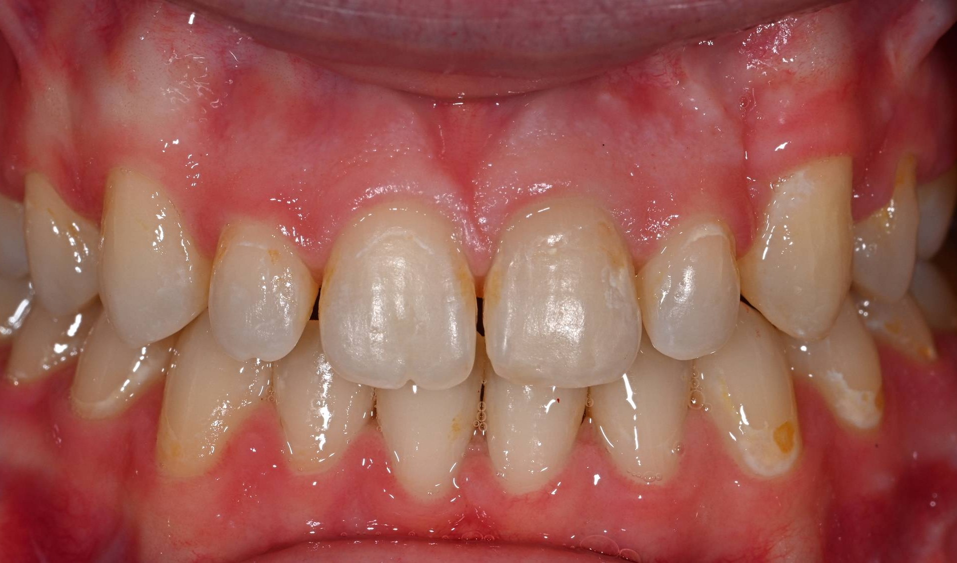 Veneers Before & After Image