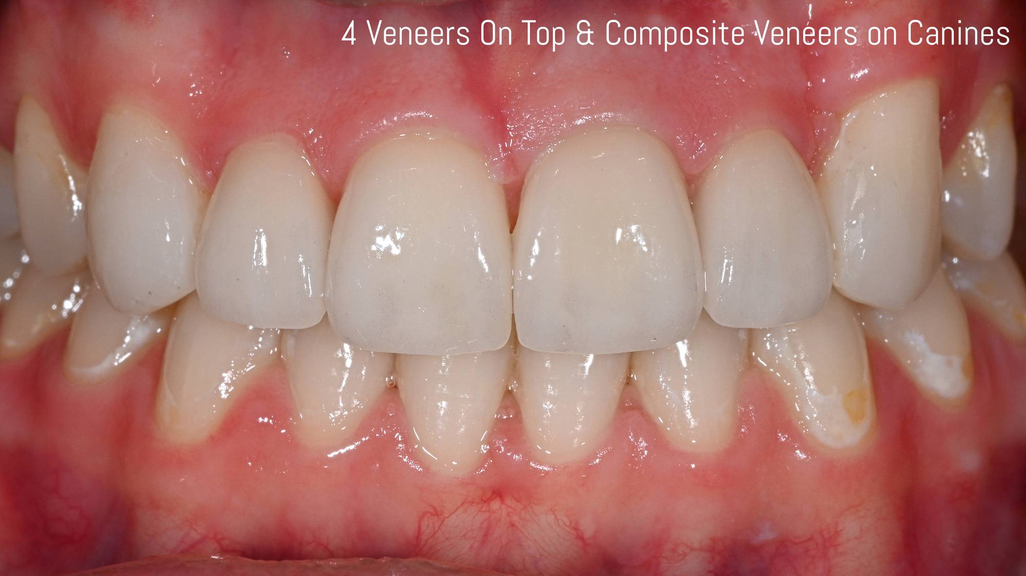 Veneers Before & After Image