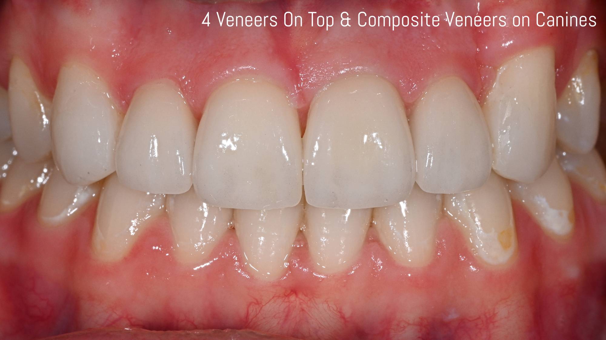 Veneers Before & After Image