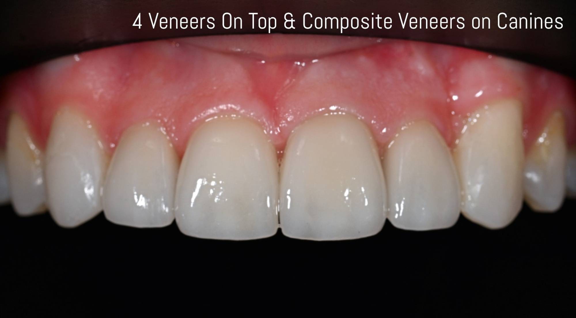 Veneers Before & After Image